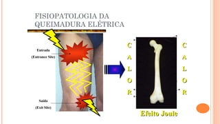 FISIOPATOLOGIA DA
QUEIMADURA ELÉTRICA
Entrada
(Entrance Site)
Saída
(Exit Site)
C
C
A
A
L
L
O
O
R
R
C
C
A
A
L
L
O
O
R
R
Efeito Joule
Efeito Joule
 