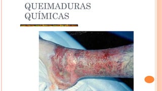 QUEIMADURAS
QUÍMICAS
 
