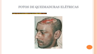 FOTOS DE QUEIMADURAS ELÉTRICAS
 