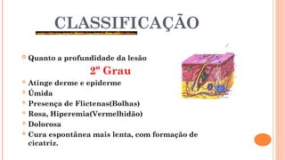 CLASSIFICAÇÃO
 Quanto a profundidade da lesão
2º Grau
 Atinge derme e epiderme
 Úmida
 Presença de Flictenas(Bolhas)
 Rosa, Hiperemia(Vermelhidão)
 Dolorosa
 Cura espontânea mais lenta, com formação de
cicatriz.
 