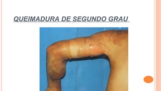 QUEIMADURA DE SEGUNDO GRAU
 