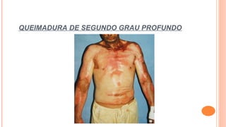 QUEIMADURA DE SEGUNDO GRAU PROFUNDO
 