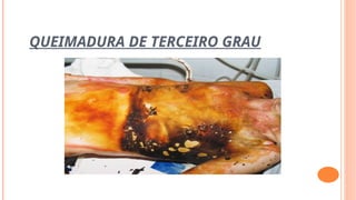 QUEIMADURA DE TERCEIRO GRAU
 