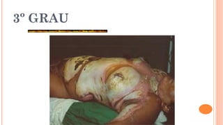 3º GRAU
 