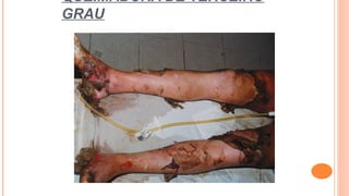 QUEIMADURA DE TERCEIRO
GRAU
 