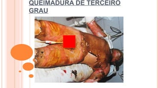 QUEIMADURA DE TERCEIRO
GRAU
 