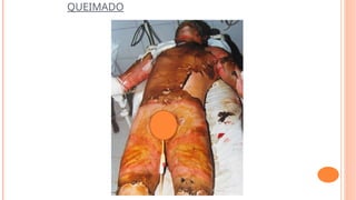 QUEIMADO
 