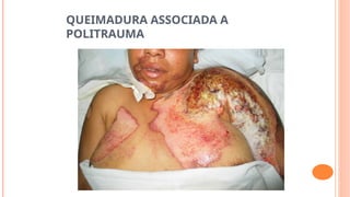QUEIMADURA ASSOCIADA A
POLITRAUMA
 