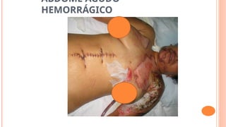 ABDOME AGUDO
HEMORRÁGICO
 