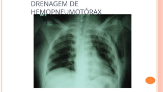 DRENAGEM DE
HEMOPNEUMOTÓRAX
 