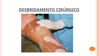 DESBRIDAMENTO CIRÚRGICO
 