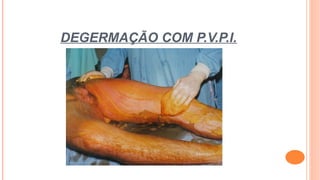 DEGERMAÇÃO COM P.V.P.I.
 