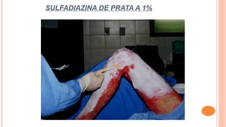 SULFADIAZINA DE PRATA A 1%
 