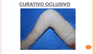 CURATIVO OCLUSIVO
 