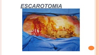 ESCAROTOMIA
 