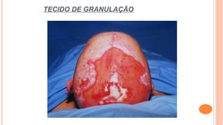 TECIDO DE GRANULAÇÃO
 