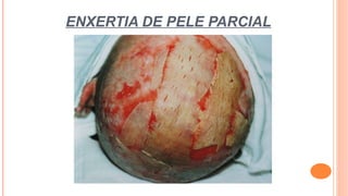 ENXERTIA DE PELE PARCIAL
 