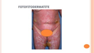 FOTOFITODERMATITE
 