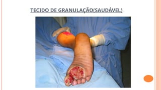 TECIDO DE GRANULAÇÃO(SAUDÁVEL)
 