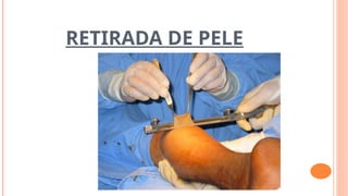 RETIRADA DE PELE
 