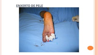 ENXERTO DE PELE
 