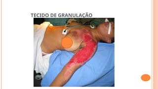 TECIDO DE GRANULAÇÃO
 