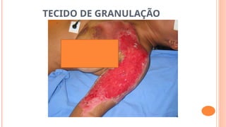 TECIDO DE GRANULAÇÃO
 