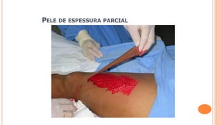 PELE DE ESPESSURA PARCIAL
 