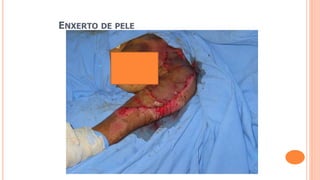 ENXERTO DE PELE
 