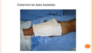 CURATIVO NA ÁREA DOADORA
 