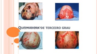 QUEIMADURA DE TERCEIRO GRAU
Enxertia de pele
 