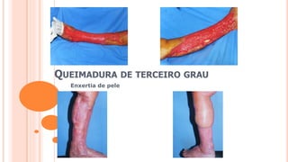 QUEIMADURA DE TERCEIRO GRAU
Enxertia de pele
 