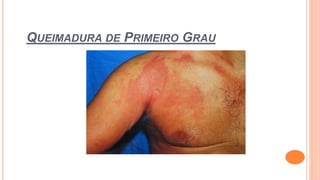 QUEIMADURA DE PRIMEIRO GRAU
 