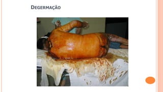 DEGERMAÇÃO
 