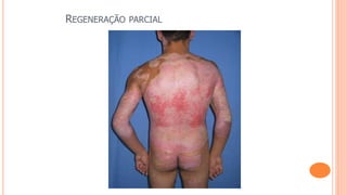 REGENERAÇÃO PARCIAL
 