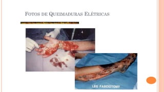 FOTOS DE QUEIMADURAS ELÉTRICAS
 