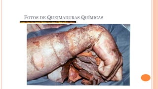 FOTOS DE QUEIMADURAS QUÍMICAS
 
