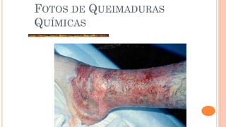 FOTOS DE QUEIMADURAS
QUÍMICAS
 