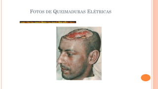FOTOS DE QUEIMADURAS ELÉTRICAS
 