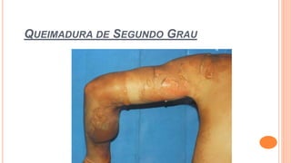 QUEIMADURA DE SEGUNDO GRAU
 