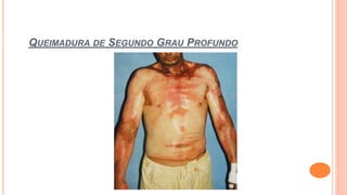 QUEIMADURA DE SEGUNDO GRAU PROFUNDO
 