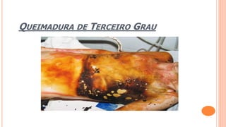 QUEIMADURA DE TERCEIRO GRAU
 