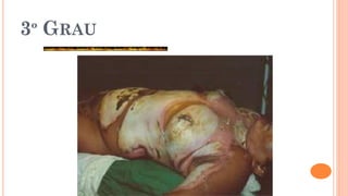 3º GRAU
 
