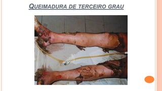 QUEIMADURA DE TERCEIRO GRAU
 