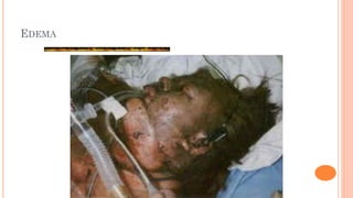 EDEMA
 