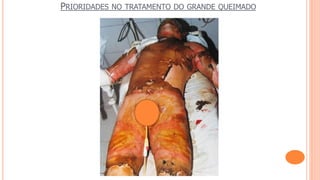 PRIORIDADES NO TRATAMENTO DO GRANDE QUEIMADO
 