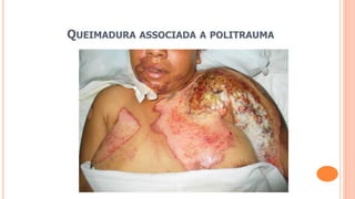 QUEIMADURA ASSOCIADA A POLITRAUMA
 