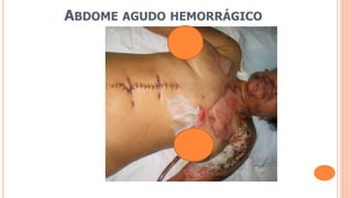 ABDOME AGUDO HEMORRÁGICO
 