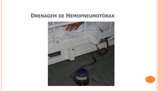 DRENAGEM DE HEMOPNEUMOTÓRAX
 