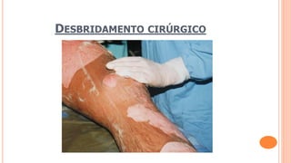 DESBRIDAMENTO CIRÚRGICO
 